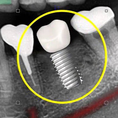 3D image of the dental implant technology Dr. Yadani uses at Manchester Advanced Dental